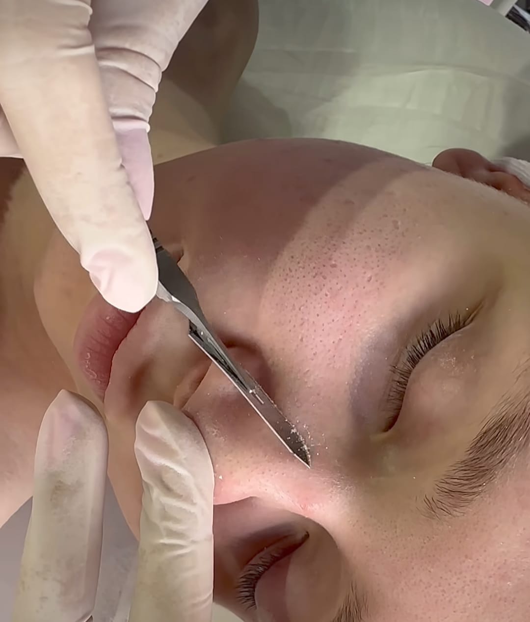 Close da técnica com lâmina aplicada no rosto de uma paciente deitada, com a profissional usando luvas